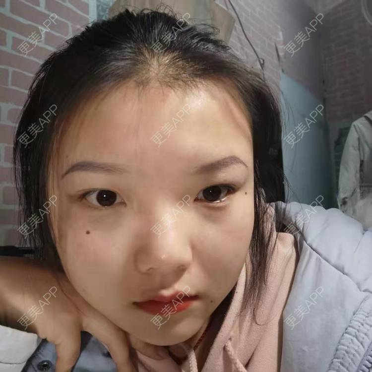 更美 - 达令达令狐的激光点痣经验 | 红蓝光清痘 | 激光淡化胎记 | 激光点痣 | 冷冻去痣 | 淡斑套餐 | 激光淡化红血丝 | 综合淡疤 | 注射淡疤 | 激光淡疤 | 激光淡斑 | 皮秒激光 | 手术去胎记