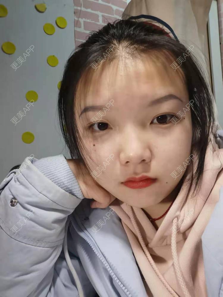 更美 - 达令达令狐的激光点痣经验 | 红蓝光清痘 | 激光淡化胎记 | 激光点痣 | 冷冻去痣 | 淡斑套餐 | 激光淡化红血丝 | 综合淡疤 | 注射淡疤 | 激光淡疤 | 激光淡斑 | 皮秒激光 | 手术去胎记