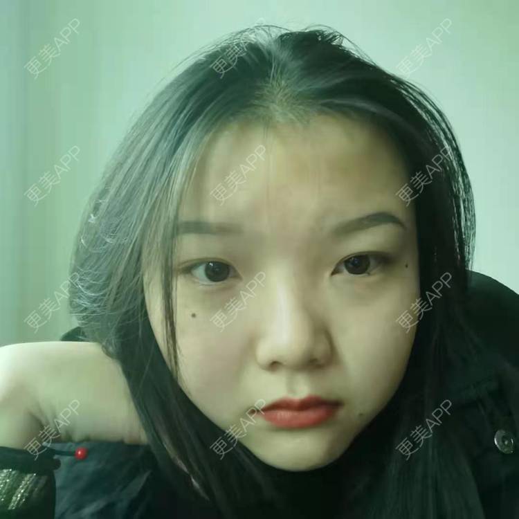 更美 - 达令达令狐的激光点痣经验 | 红蓝光清痘 | 激光淡化胎记 | 激光点痣 | 冷冻去痣 | 淡斑套餐 | 激光淡化红血丝 | 综合淡疤 | 注射淡疤 | 激光淡疤 | 激光淡斑 | 皮秒激光 | 手术去胎记