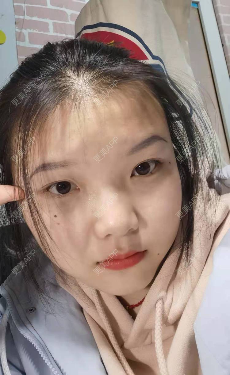 更美 - 达令达令狐的激光点痣经验 | 红蓝光清痘 | 激光淡化胎记 | 激光点痣 | 冷冻去痣 | 淡斑套餐 | 激光淡化红血丝 | 综合淡疤 | 注射淡疤 | 激光淡疤 | 激光淡斑 | 皮秒激光 | 手术去胎记