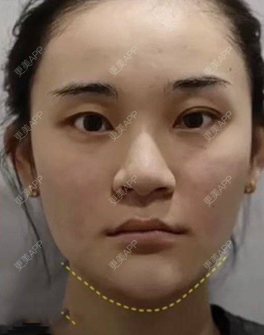 更美 - 高奉 医生的玻尿酸下巴经验 | 玻尿酸下巴 | 玻尿酸法令纹 | 沈阳