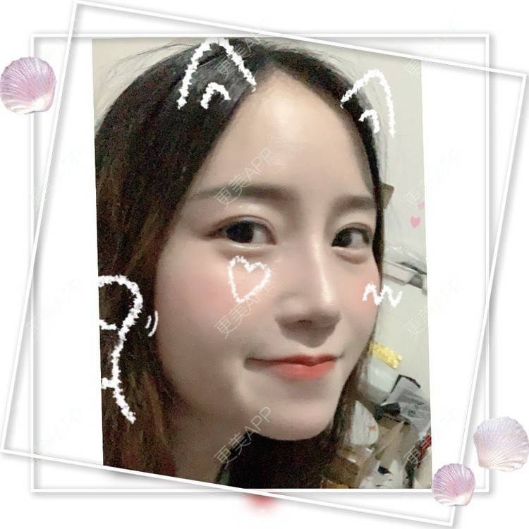 更美 - 圆方脸课代表ʚ😊ɞ的隆鼻经验 | 隆鼻 | 假体垫鼻基底 | 硅胶隆鼻 | 鼻部多项 | 全切双眼皮 | 开内眼角 | 自体软骨垫鼻尖 | 南京 | 耳软骨隆鼻 | 视频日记