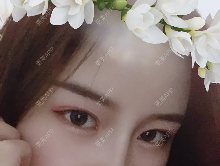 更美 - 圆方脸课代表ʚ😊ɞ的隆鼻经验 | 隆鼻 | 假体垫鼻基底 | 硅胶隆鼻 | 鼻部多项 | 全切双眼皮 | 开内眼角 | 自体软骨垫鼻尖 | 南京 | 耳软骨隆鼻 | 视频日记