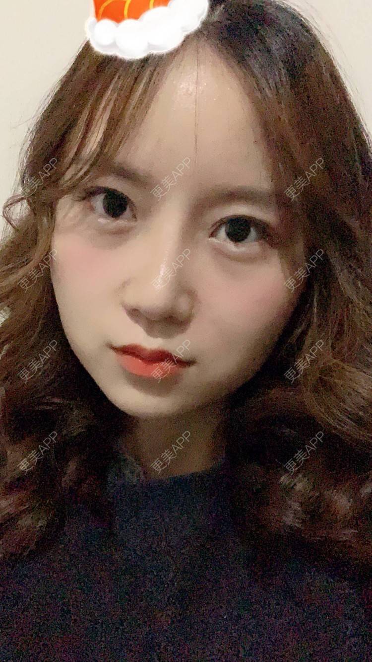 更美 - 圆方脸课代表ʚ😊ɞ的隆鼻经验 | 隆鼻 | 假体垫鼻基底 | 硅胶隆鼻 | 鼻部多项 | 全切双眼皮 | 开内眼角 | 自体软骨垫鼻尖 | 南京 | 耳软骨隆鼻 | 视频日记