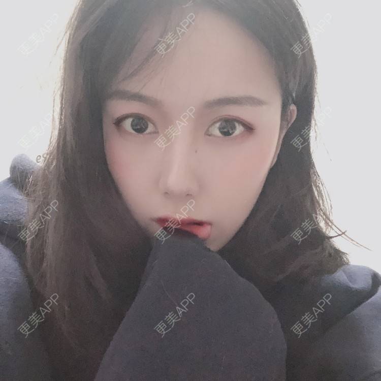 更美 - 咪狐狸的自体脂肪丰面颊经验 | 自体脂肪全面部填充 | 自体脂肪丰面颊 | 深圳 | 自体脂肪面部年轻化 | 自体脂肪面部填充