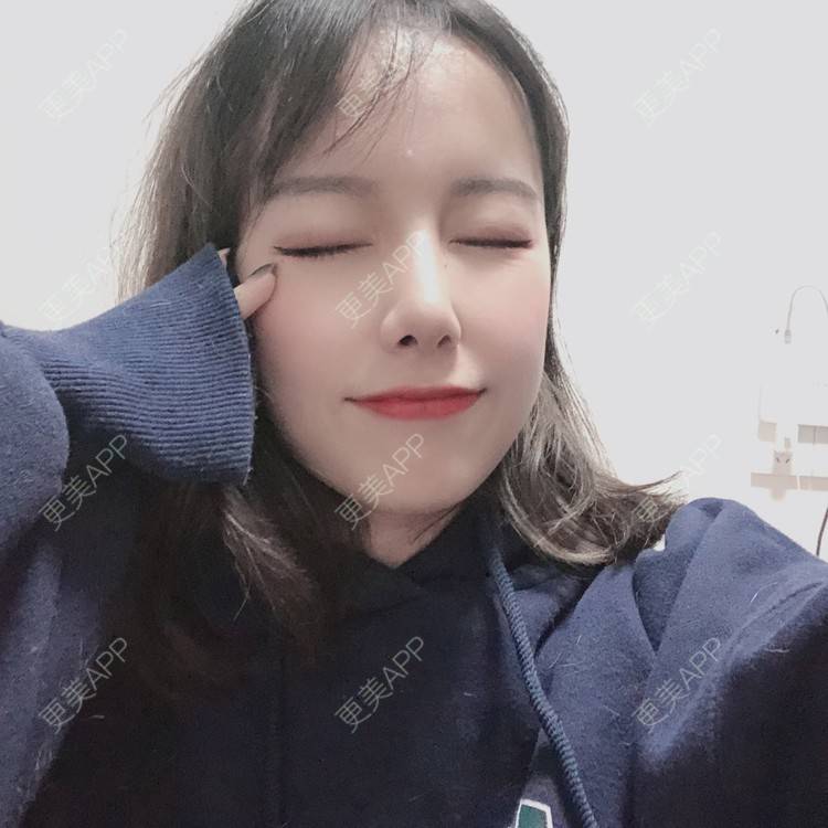 更美 - 咪狐狸的自体脂肪丰面颊经验 | 自体脂肪全面部填充 | 自体脂肪丰面颊 | 深圳 | 自体脂肪面部年轻化 | 自体脂肪面部填充