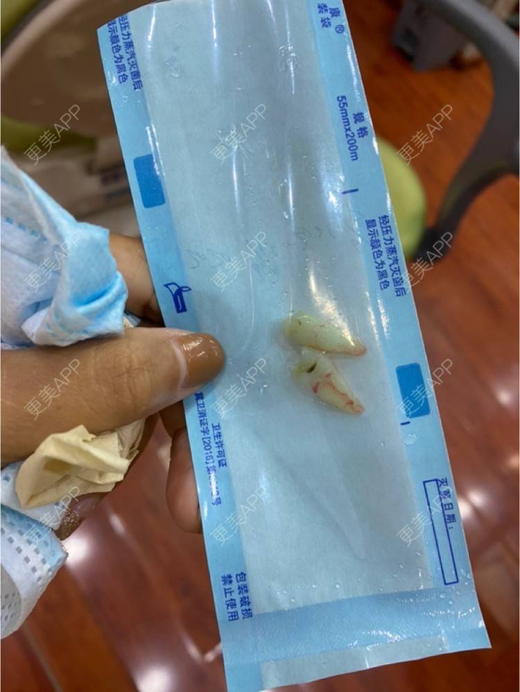 分享到:拔齲齒圖片推薦商品【拔齲齒】【口腔拔牙】微創舒適智齒拔除