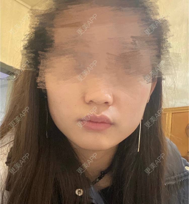 更美 - 用户5928936135的除皱瘦脸经验 | 除皱瘦脸 | 重庆