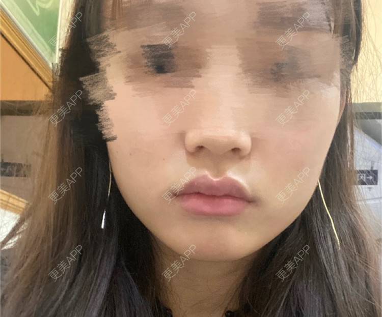 更美 - 用户5928936135的除皱瘦脸经验 | 除皱瘦脸 | 重庆