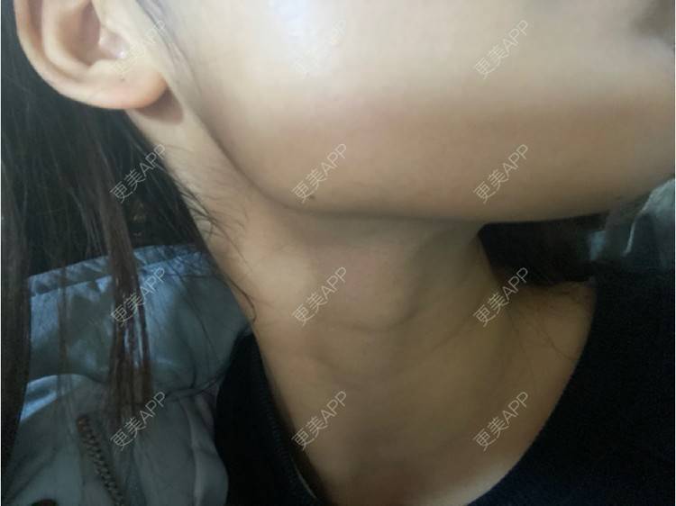 更美 - 用户5928936135的除皱瘦脸经验 | 除皱瘦脸 | 重庆