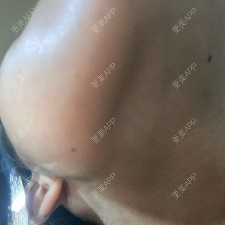 更美 - 用户5928936135的除皱瘦脸经验 | 除皱瘦脸 | 重庆