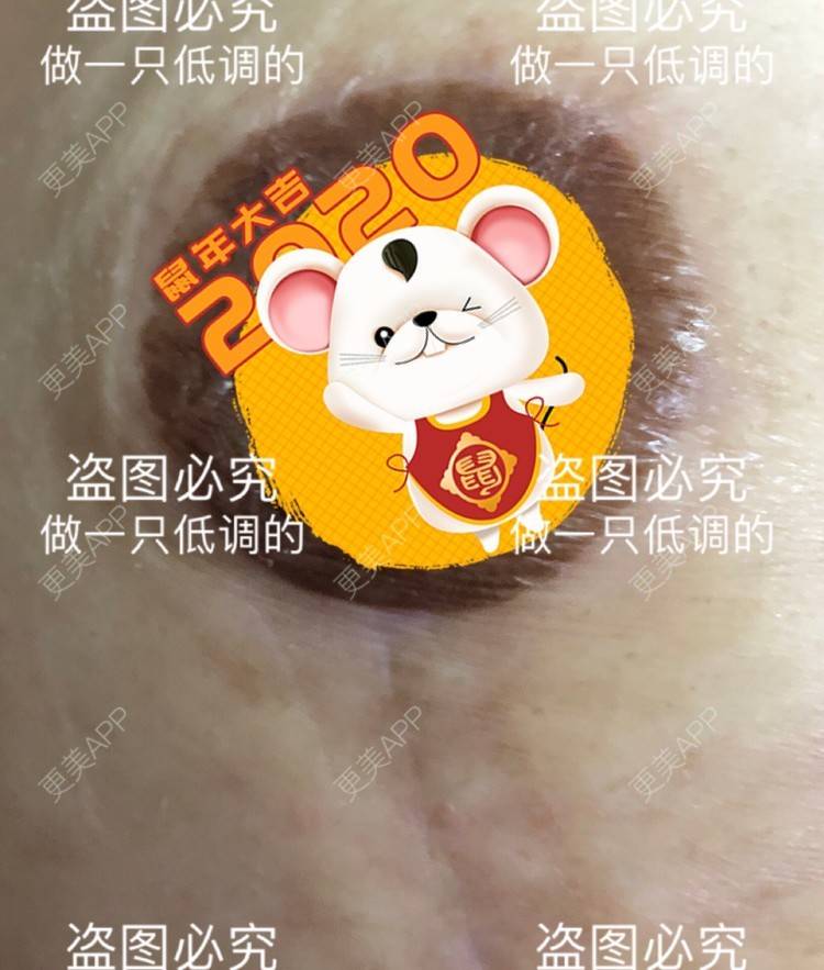 更美 - 更美用户ZN5LsrY6bk的乳晕缩小经验 | 乳晕缩小 | 缩胸手术 | 胸部下垂矫正 | 杭州