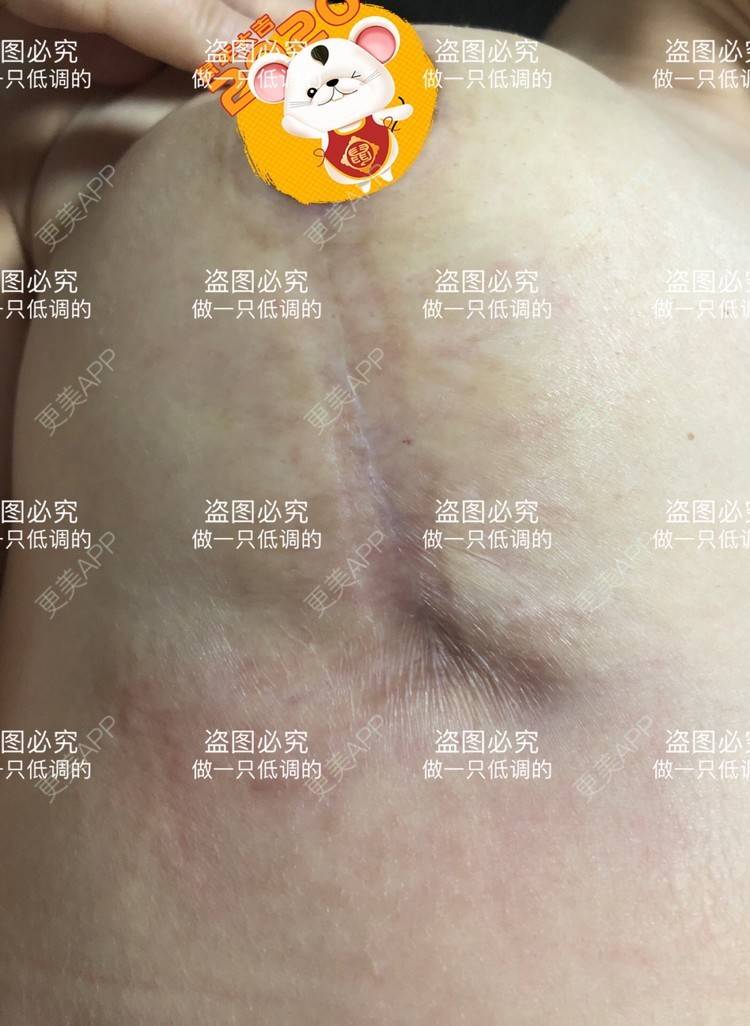 更美 - 更美用户ZN5LsrY6bk的乳晕缩小经验 | 乳晕缩小 | 缩胸手术 | 胸部下垂矫正 | 杭州