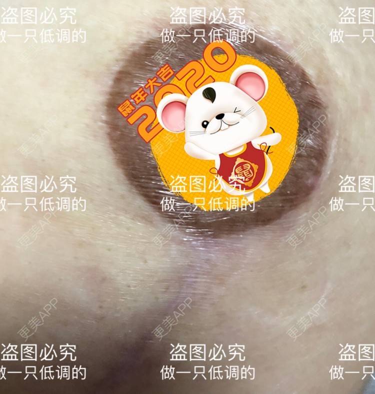 更美 - 更美用户ZN5LsrY6bk的乳晕缩小经验 | 乳晕缩小 | 缩胸手术 | 胸部下垂矫正 | 杭州