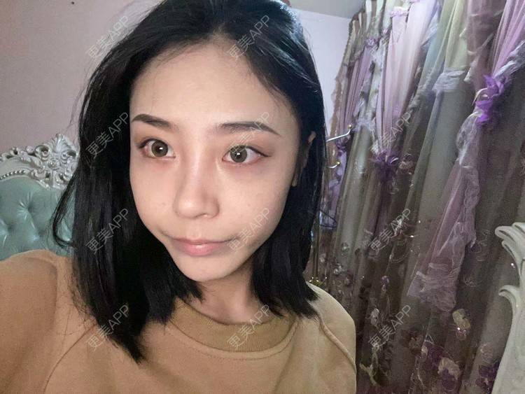 更美 - 烛雪的自体脂肪全面部填充经验 | 北京 | 自体脂肪全面部填充