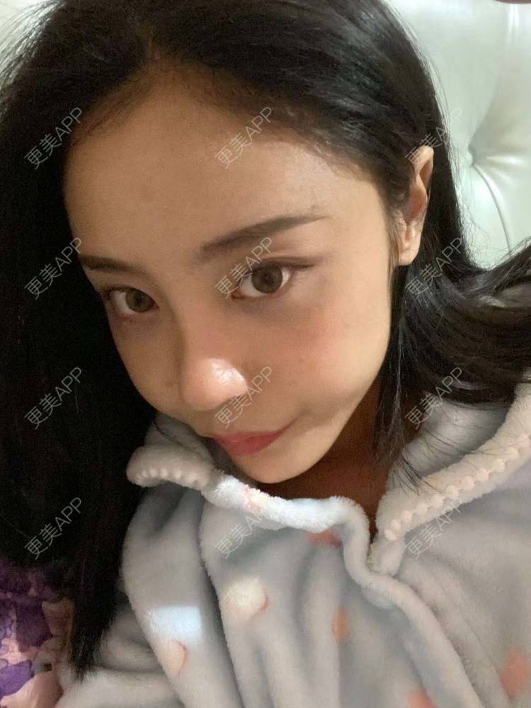 更美 - 烛雪的自体脂肪全面部填充经验 | 北京 | 自体脂肪全面部填充