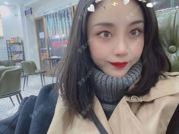 更美 - 烛雪的自体脂肪全面部填充经验 | 北京 | 自体脂肪全面部填充