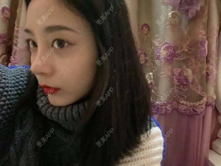 更美 - 烛雪的自体脂肪全面部填充经验 | 北京 | 自体脂肪全面部填充