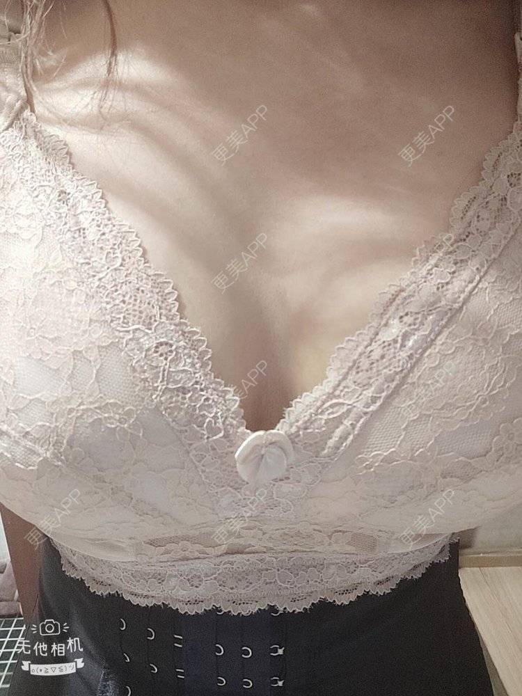 更美 - 做谁的女人★谜的自体脂肪隆胸经验 | 北京 | 自体脂肪隆胸