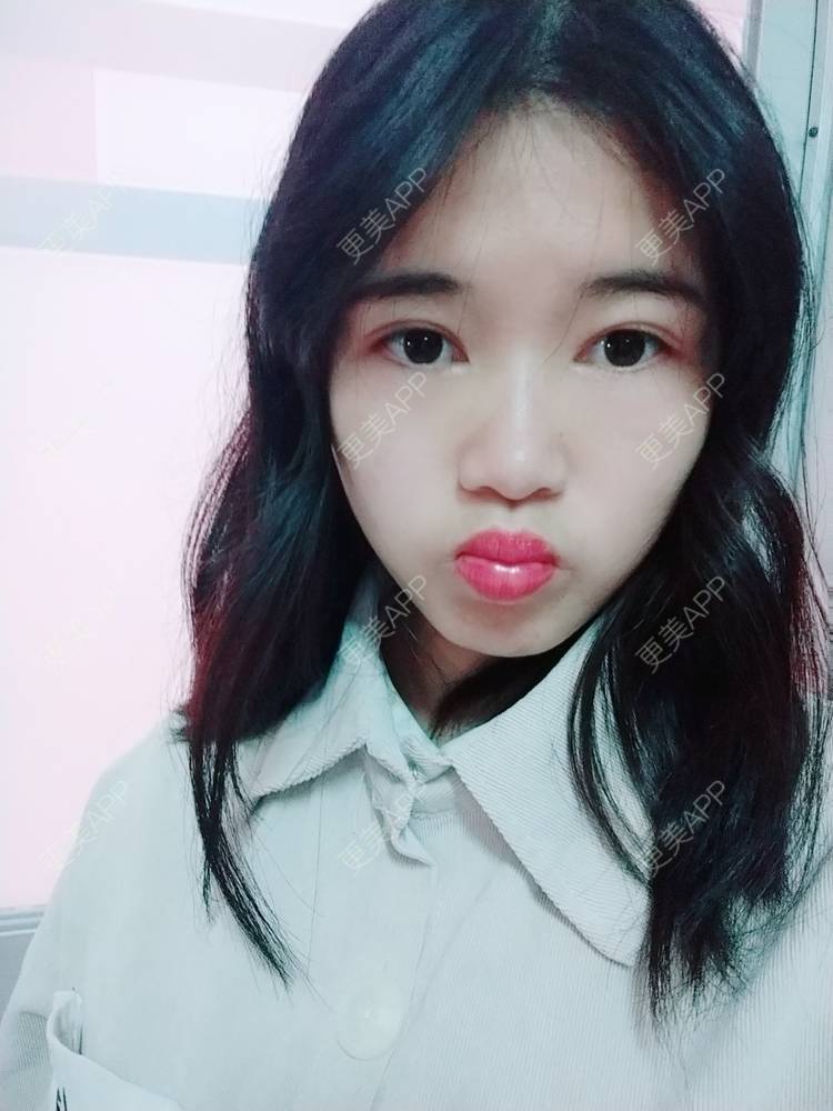 更美 - 更美用户lM8eMwz0OI的热玛吉经验 | 福州 | 热玛吉