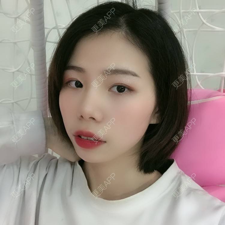 更美 - 更美用户XALPc5RVJ3的热玛吉经验 | 广州 | 热玛吉