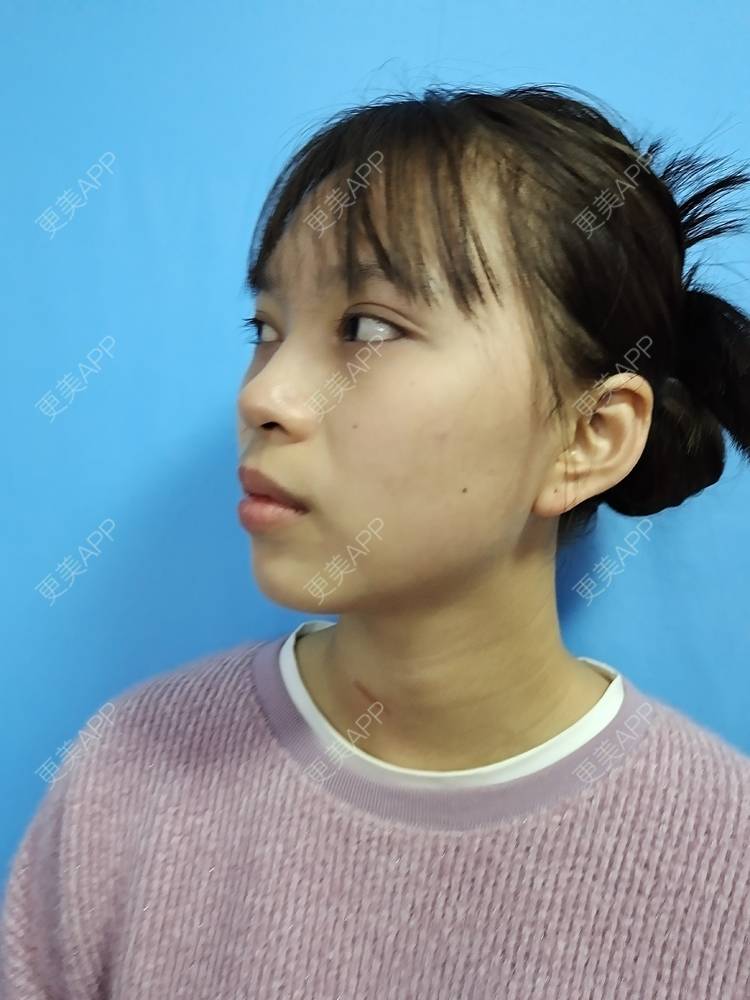 更美 - 更美用户iik9JwcRby的激光淡疤经验 | 成都 | 祛疤痕痘印 | 注射淡疤 | 激光淡疤