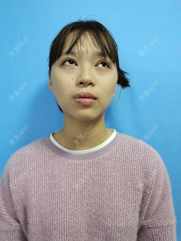 更美 - 更美用户iik9JwcRby的激光淡疤经验 | 成都 | 祛疤痕痘印 | 注射淡疤 | 激光淡疤