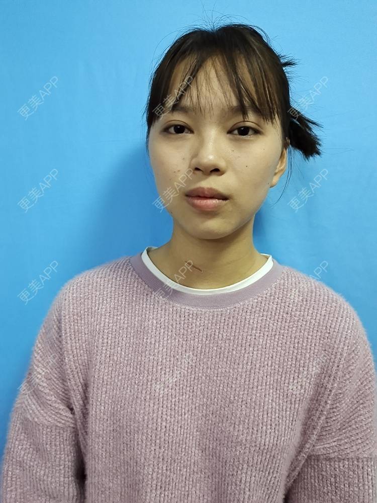 更美 - 更美用户iik9JwcRby的激光淡疤经验 | 成都 | 祛疤痕痘印 | 注射淡疤 | 激光淡疤