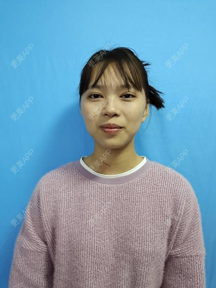 更美 - 更美用户iik9JwcRby的激光淡疤经验 | 成都 | 祛疤痕痘印 | 注射淡疤 | 激光淡疤