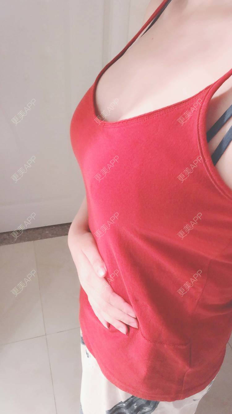 更美 - 述禾狈的自体脂肪隆胸经验 | 北京 | 自体脂肪隆胸 | 视频日记