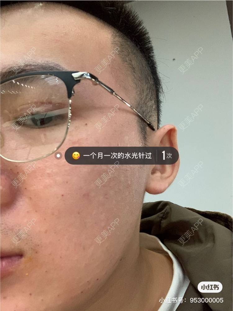更美 - 更美用户WwwH8E0LBK的水光项目经验 | 广州 | 水光项目