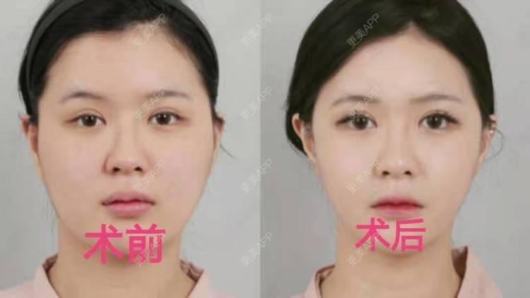 更美 - 更美用户IjsbS0aExT的祛皱经验 | 热玛吉 | 祛皱