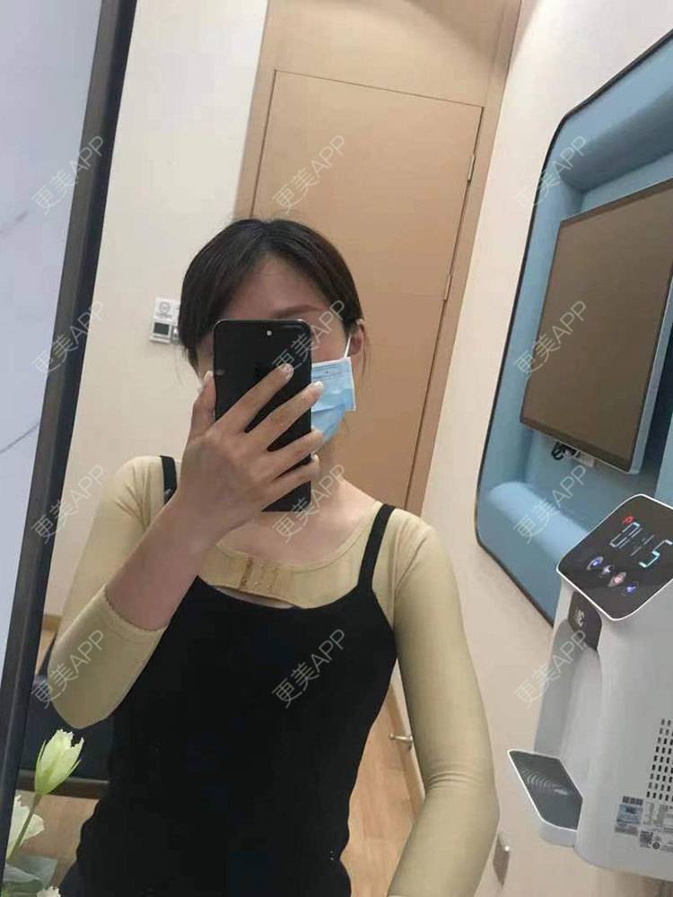 更美 - 更美用户he4cSABruG的手臂吸脂经验 | 手臂吸脂 | 广州