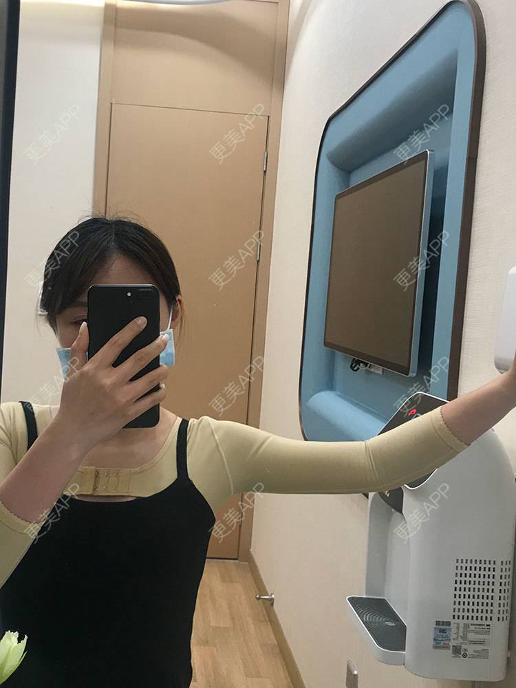 更美 - 更美用户he4cSABruG的手臂吸脂经验 | 手臂吸脂 | 广州