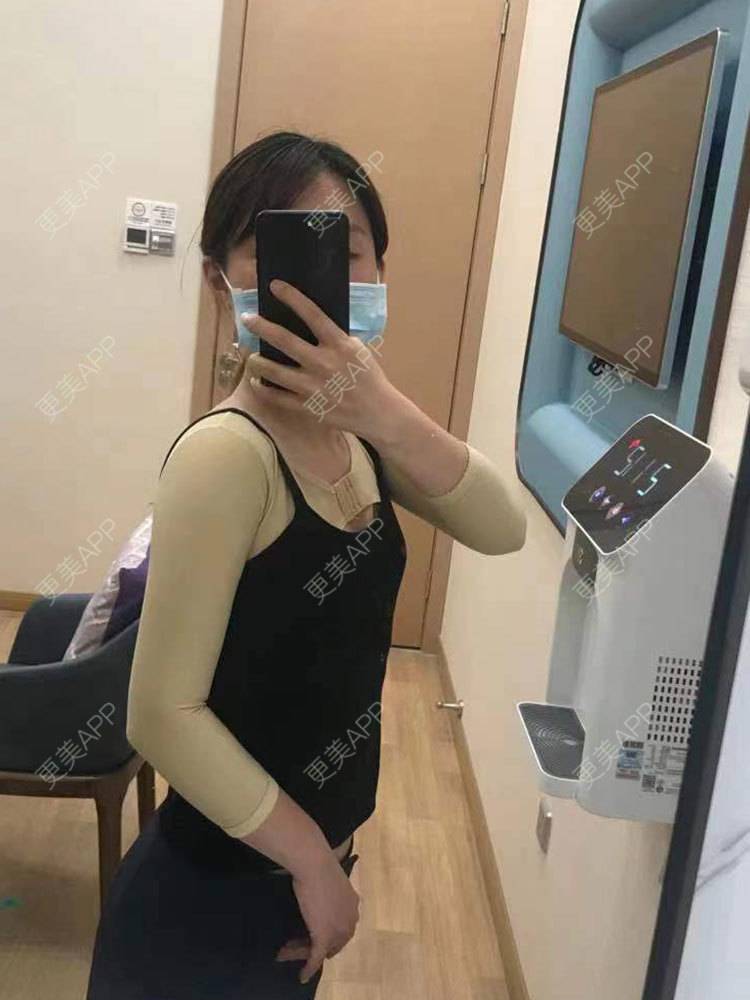 更美 - 更美用户he4cSABruG的手臂吸脂经验 | 手臂吸脂 | 广州