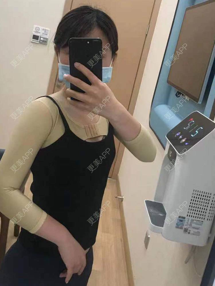 更美 - 更美用户he4cSABruG的手臂吸脂经验 | 手臂吸脂 | 广州