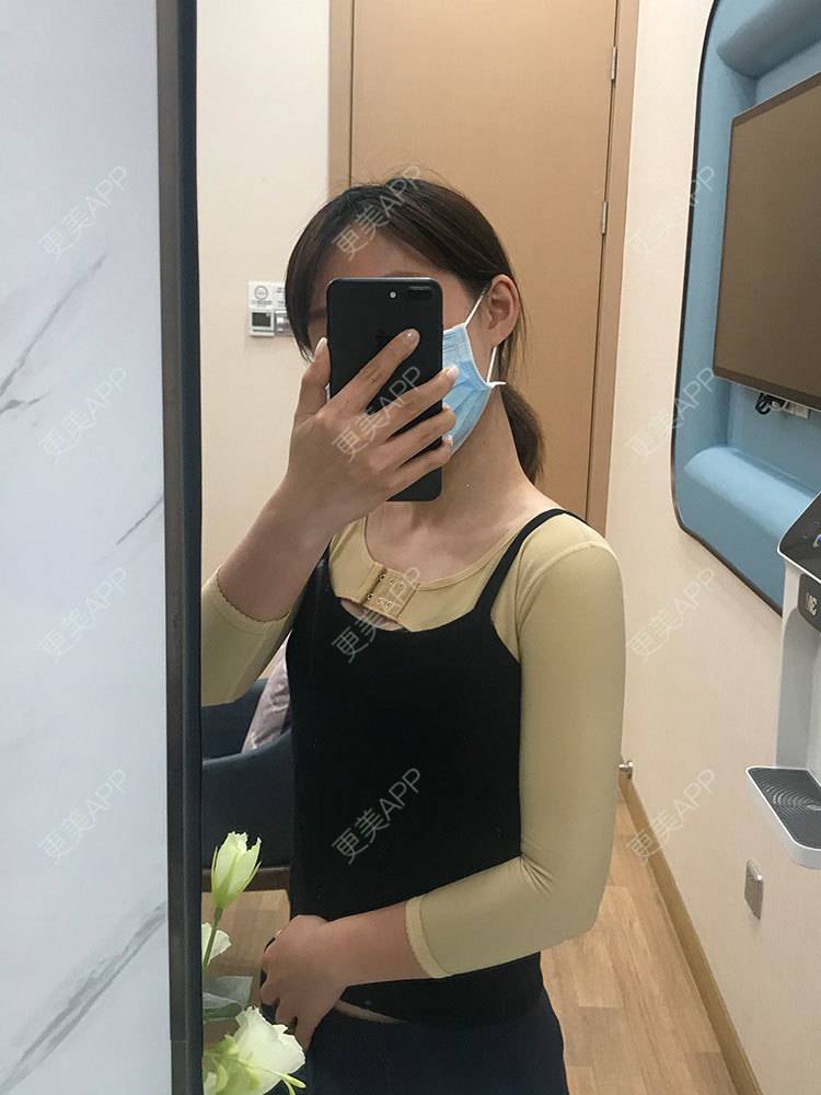 更美 - 更美用户he4cSABruG的手臂吸脂经验 | 手臂吸脂 | 广州