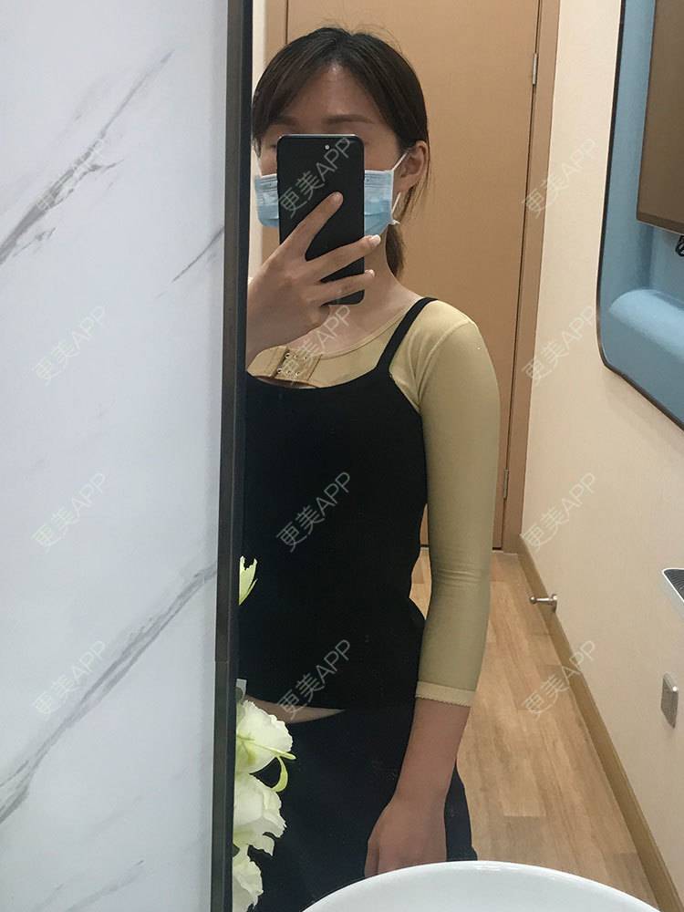 更美 - 更美用户he4cSABruG的手臂吸脂经验 | 手臂吸脂 | 广州