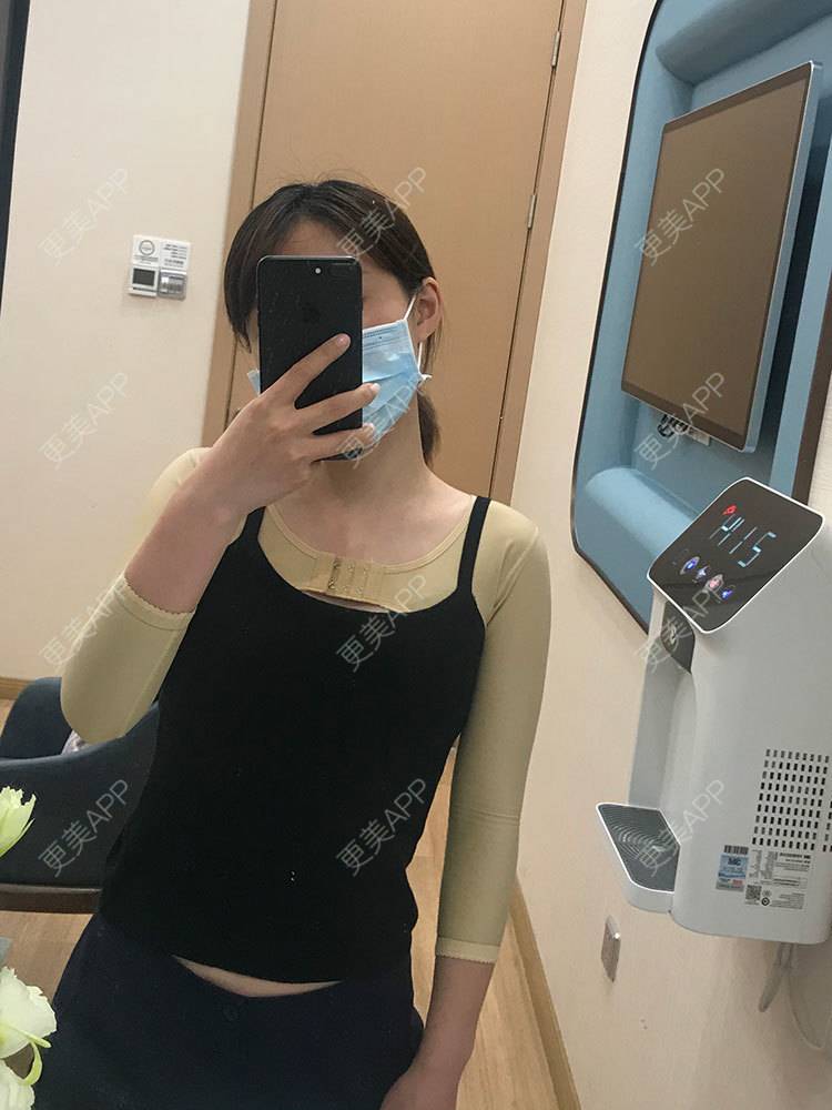 更美 - 更美用户he4cSABruG的手臂吸脂经验 | 手臂吸脂 | 广州