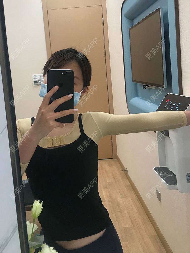 更美 - 更美用户he4cSABruG的手臂吸脂经验 | 手臂吸脂 | 广州