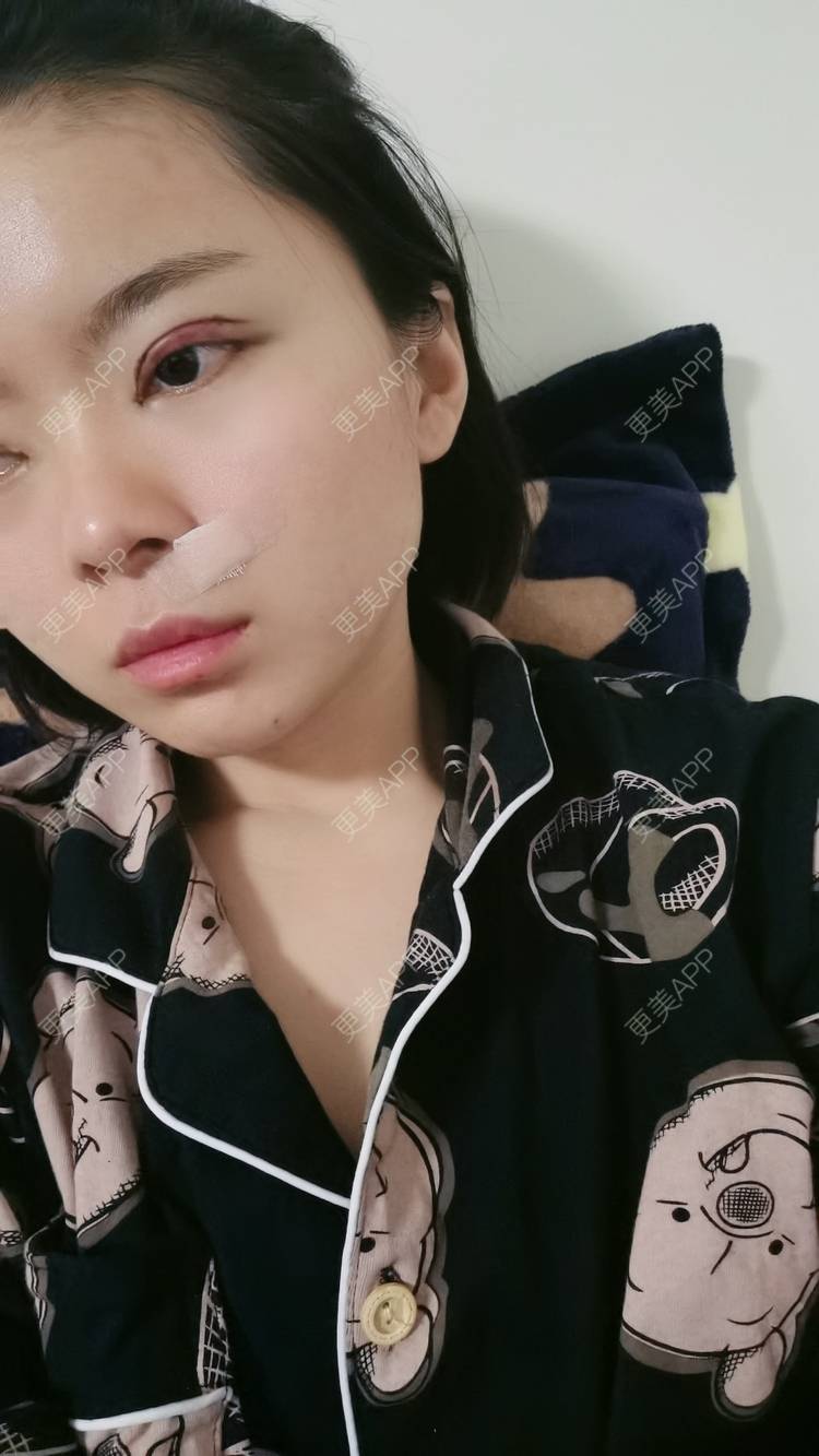更美 - 小太阳77的手术淡疤经验 | 激光点痣 | 手术淡疤