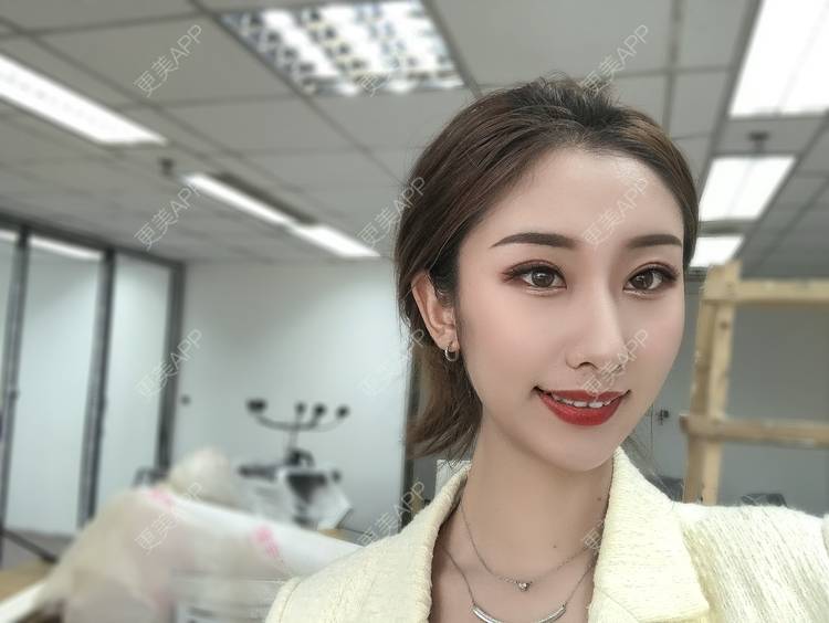 更美 - Gonve1的颧骨内推经验 | 广州 | 颧骨内推 | 视频日记