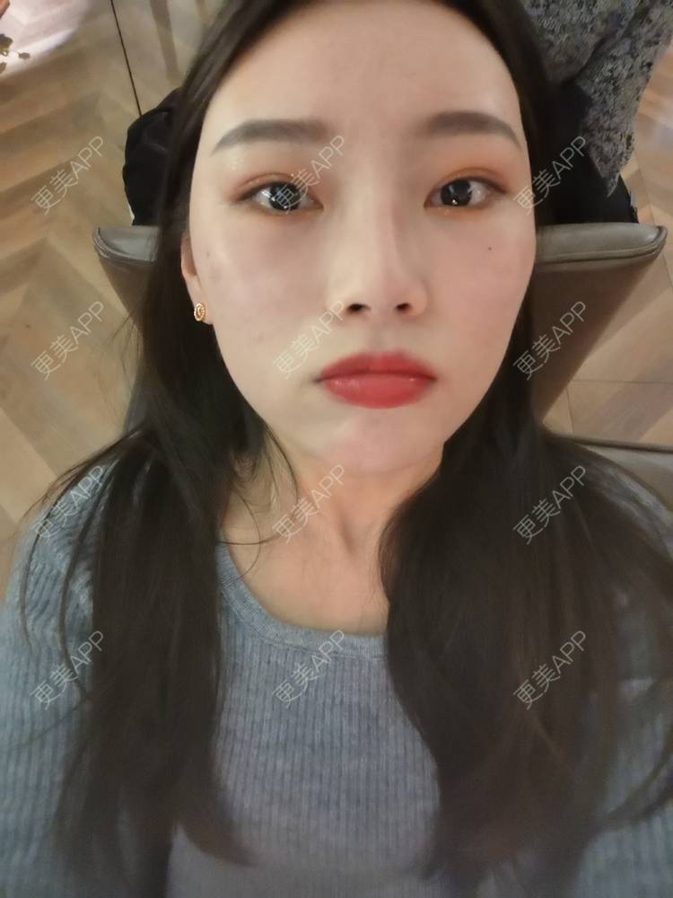 更美 - 更美用户82701801的树脂补牙经验 | 杭州 | 树脂补牙