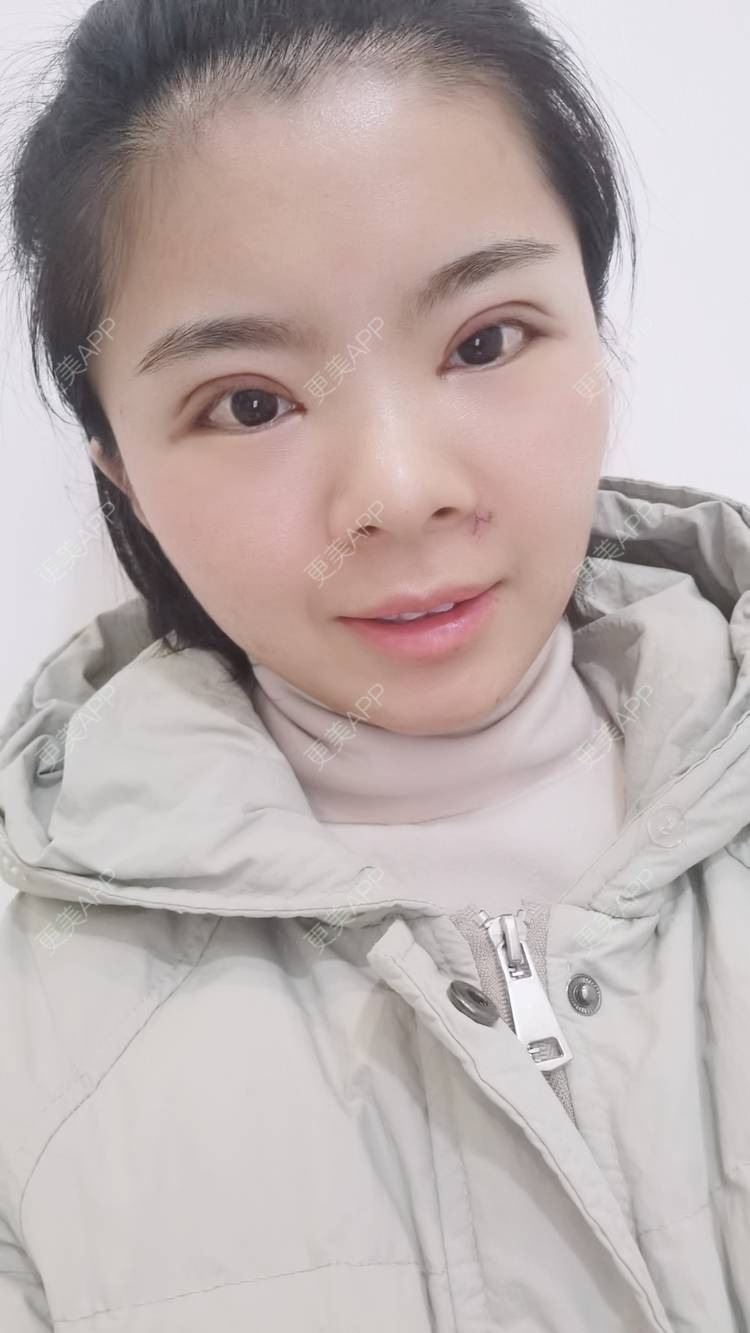 更美 - 小太阳77的手术淡疤经验 | 激光点痣 | 手术淡疤
