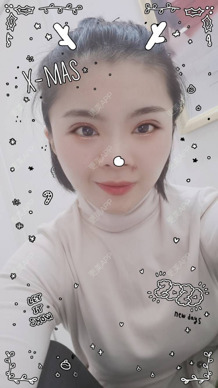 更美 - 小太阳77的手术淡疤经验 | 激光点痣 | 手术淡疤