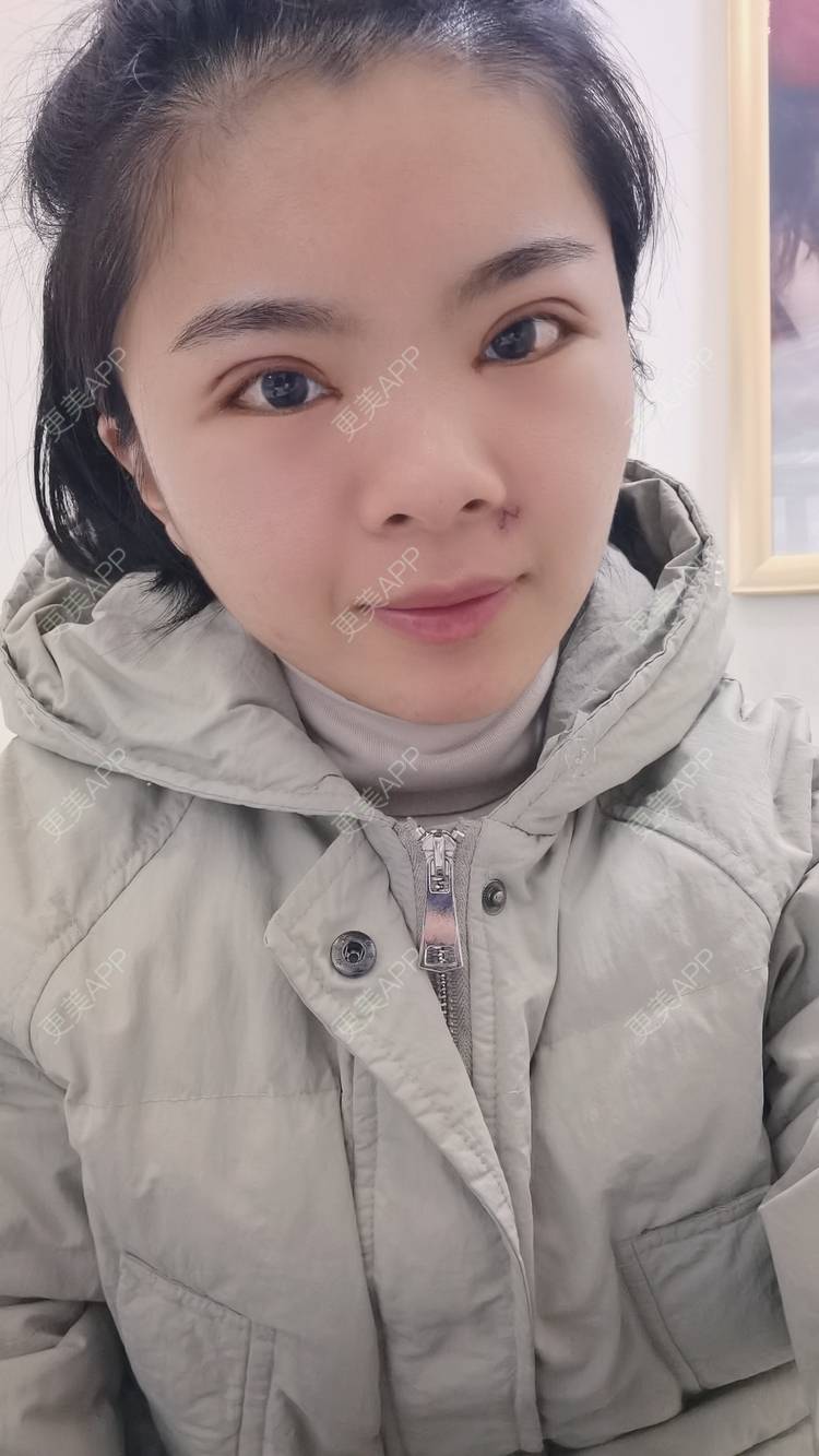 更美 - 小太阳77的手术淡疤经验 | 激光点痣 | 手术淡疤