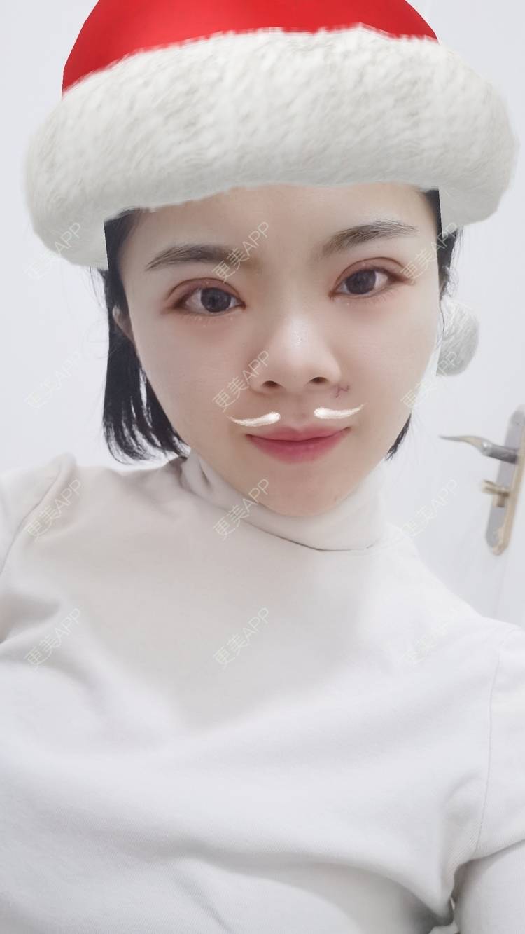 更美 - 小太阳77的手术淡疤经验 | 激光点痣 | 手术淡疤