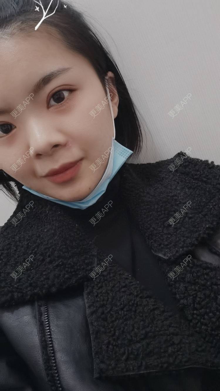 更美 - 小太阳77的手术淡疤经验 | 激光点痣 | 手术淡疤