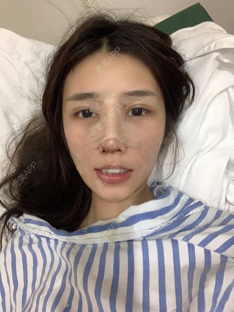 更美 - 媛媛儿~的隆鼻经验 | 隆鼻 | 肋软骨隆鼻 | 驼峰鼻矫正 | 鼻部多项 | 重庆