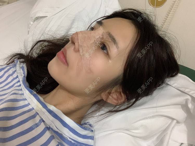 更美 - 媛媛儿~的隆鼻经验 | 隆鼻 | 肋软骨隆鼻 | 驼峰鼻矫正 | 鼻部多项 | 重庆